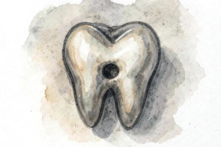 Close-up de um dente com uma cárie visível.